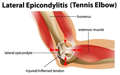 Tennis Elbow:  What is it and what to do about it.